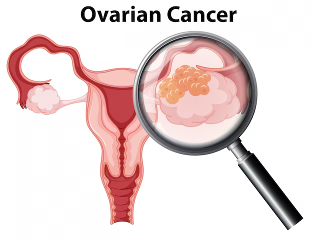 Ovarian Cancer – Symptoms, Causes, Diagnosis & Treatment Guide image 2026 04 28 125512738