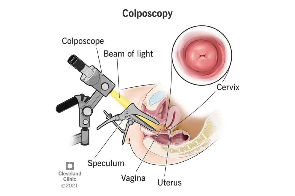 Anatomical diagram explaining the colposcopy procedure using a speculum and colposcope to examine the cervix.